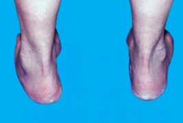 Dışa Basma Tedavisi - ORTHOGEZ