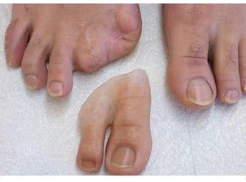 Silikon Parmak Protezi - ORTHOGEZ